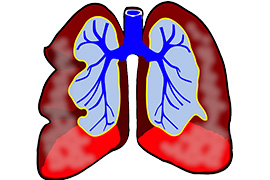 Dépistage de la broncho-pneumopathie chronique obstructive (BPCO)